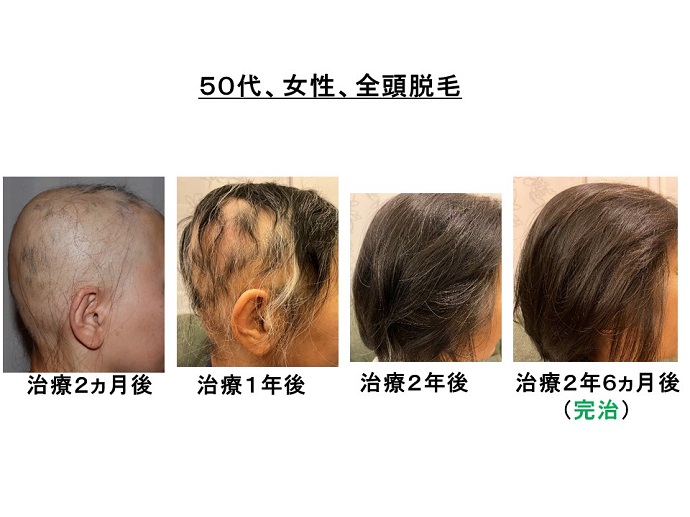 円形脱毛症　病院